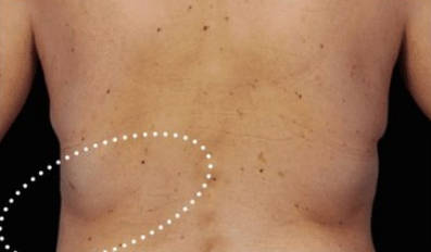 coolscuplting bra fat after midtown manhattan NYC